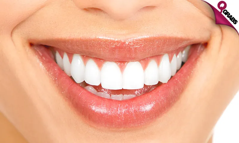 Teeth Whitening OR Home Bleaching + Consultation!